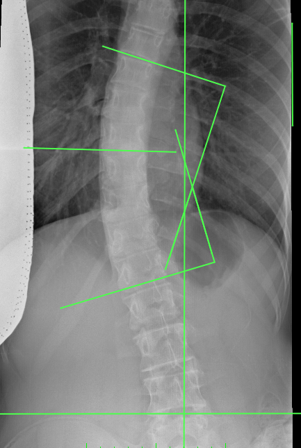 Scoliosis